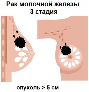 Рак молочной железы 3 стадии лечение и прогноз