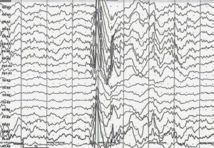ЭЭГ с эпилептической активностью