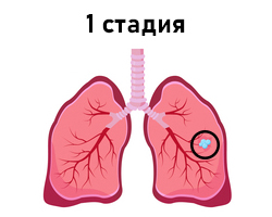 1 стадия рака лёгких