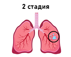 2-стадия-рака-лёгких