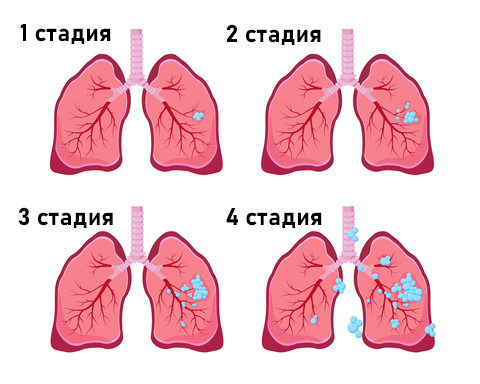 Стадии-рака-лёгких