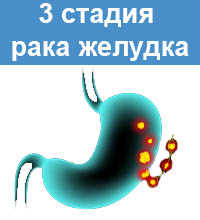 3 стадия рака желудка