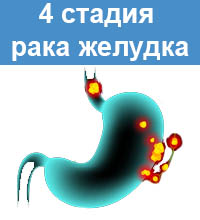4 стадия рака желудка