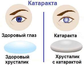 Катаракта симптомы
