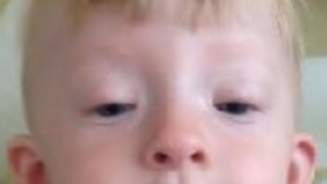 блефарофимоз у ребёнка